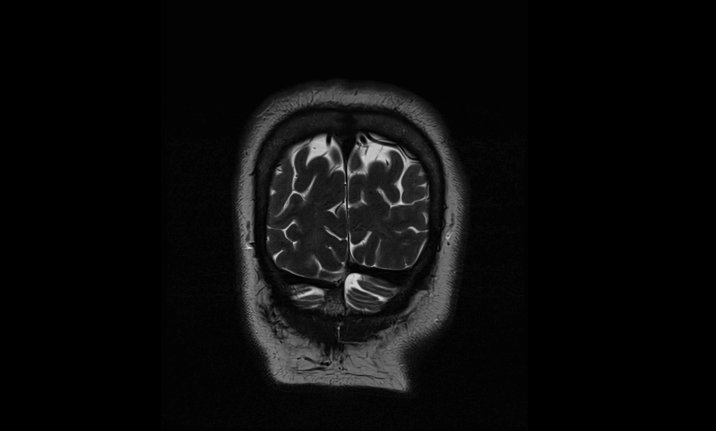 Brain cisterns  and ventricles coronal anatomy 3T MRI image-img-00001-00059.webp